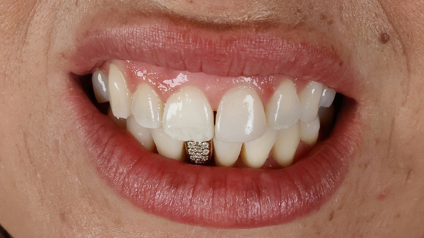 This gold and diamond permanent tooth implant was created to fill the place where a client was missing a tooth.