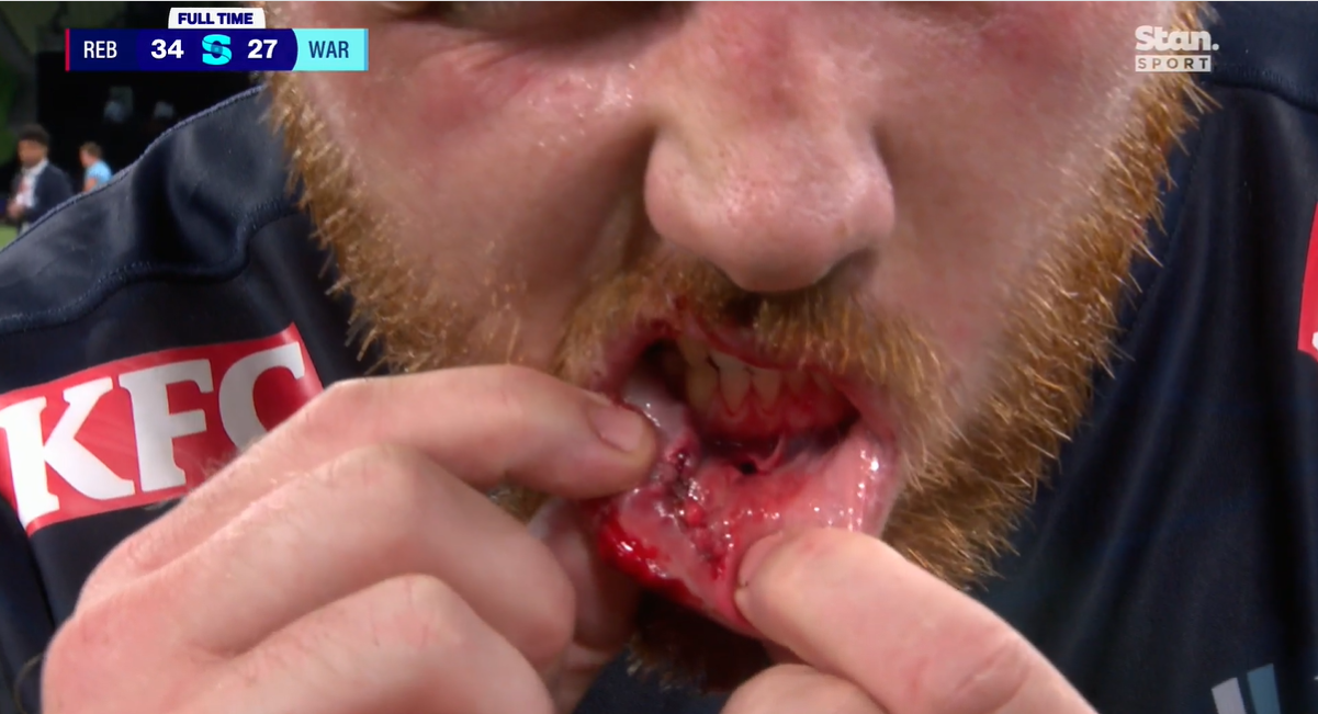 Bloodied prop Matt Gibbon pays the price for not wearing a mouthguard 