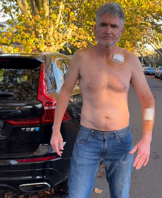 Dave Hughes in bandages after having five skin cancers removed.