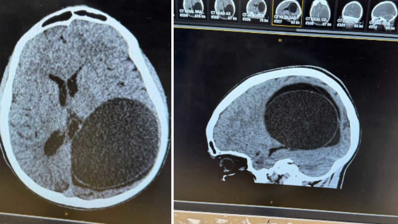 Scans of Theo Phillip's brain revealed the enormous mass, 10cm in circumference.