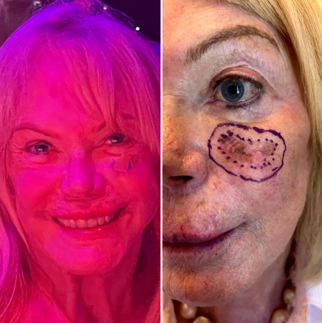 For two years and with two different doctors, Christa Billich underwent more than 12 rounds of laser.