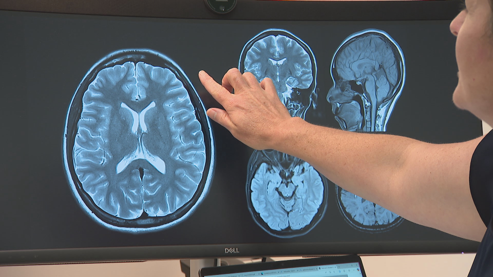 Researchers say violent dreams could indicate signalling issues in the brain and be a warning sign of Parkinson's disease.