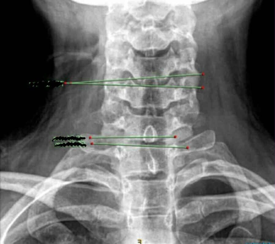 Dayna Lynch - Ehlers-Danlos syndrome