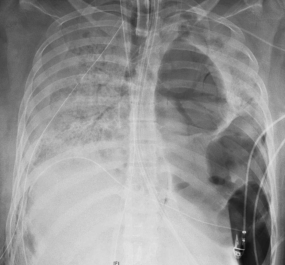 Lung transplant