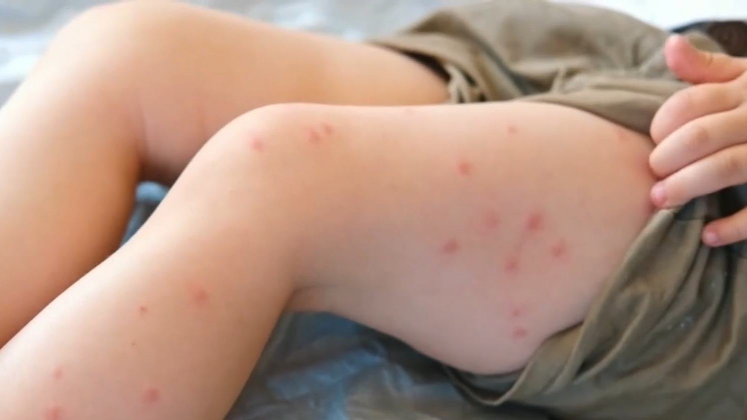 Measles cases are spiking across Queensland with residents being urged to take caution amid a fast-growing outbreak.