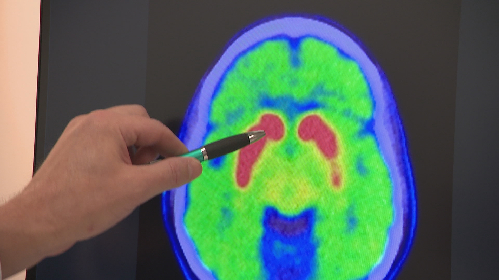 New trials hoped to stop Parkinson's disease in its tracks