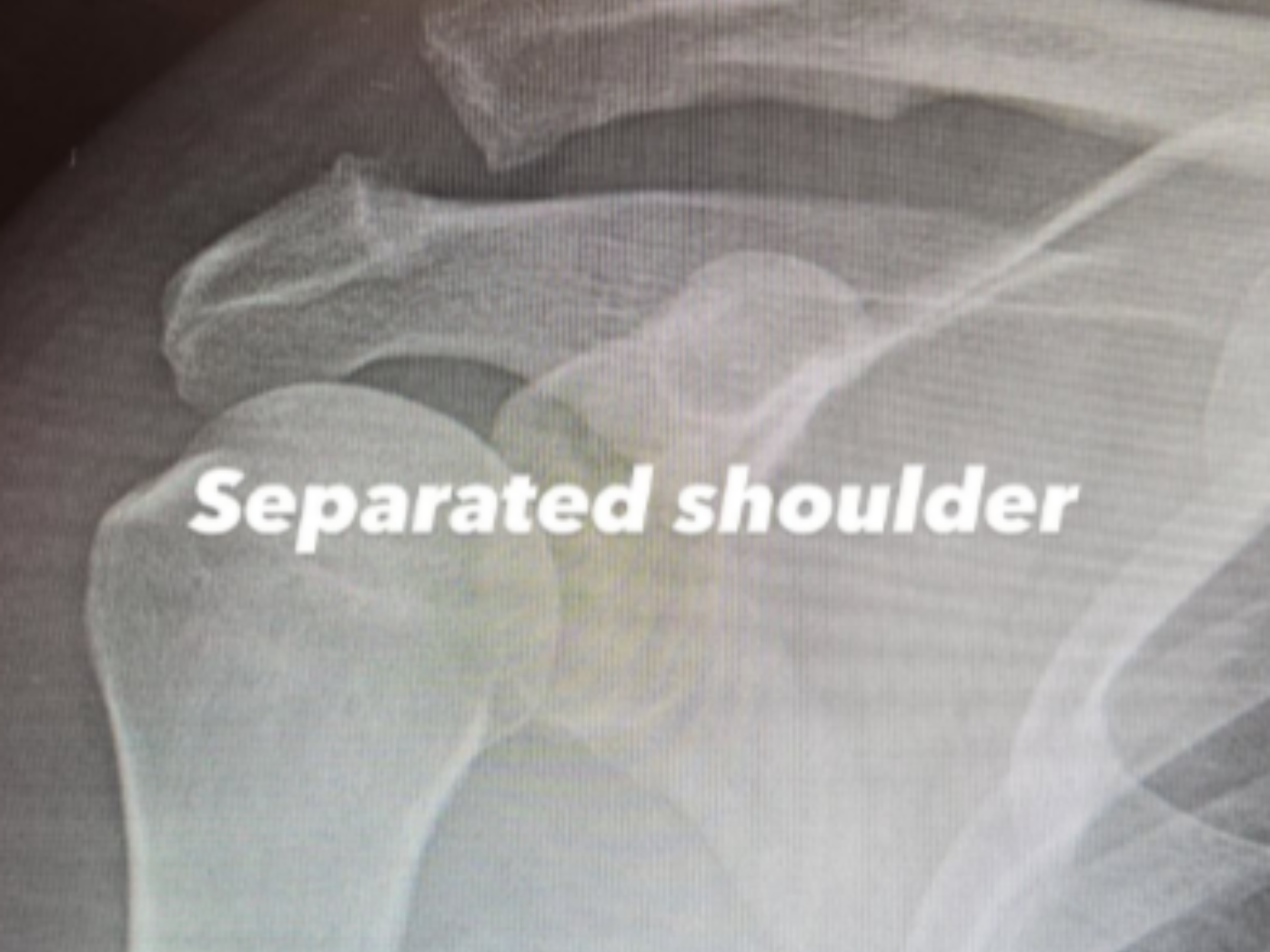 Channing Tatum shares X-ray images before and after shoulder surgery