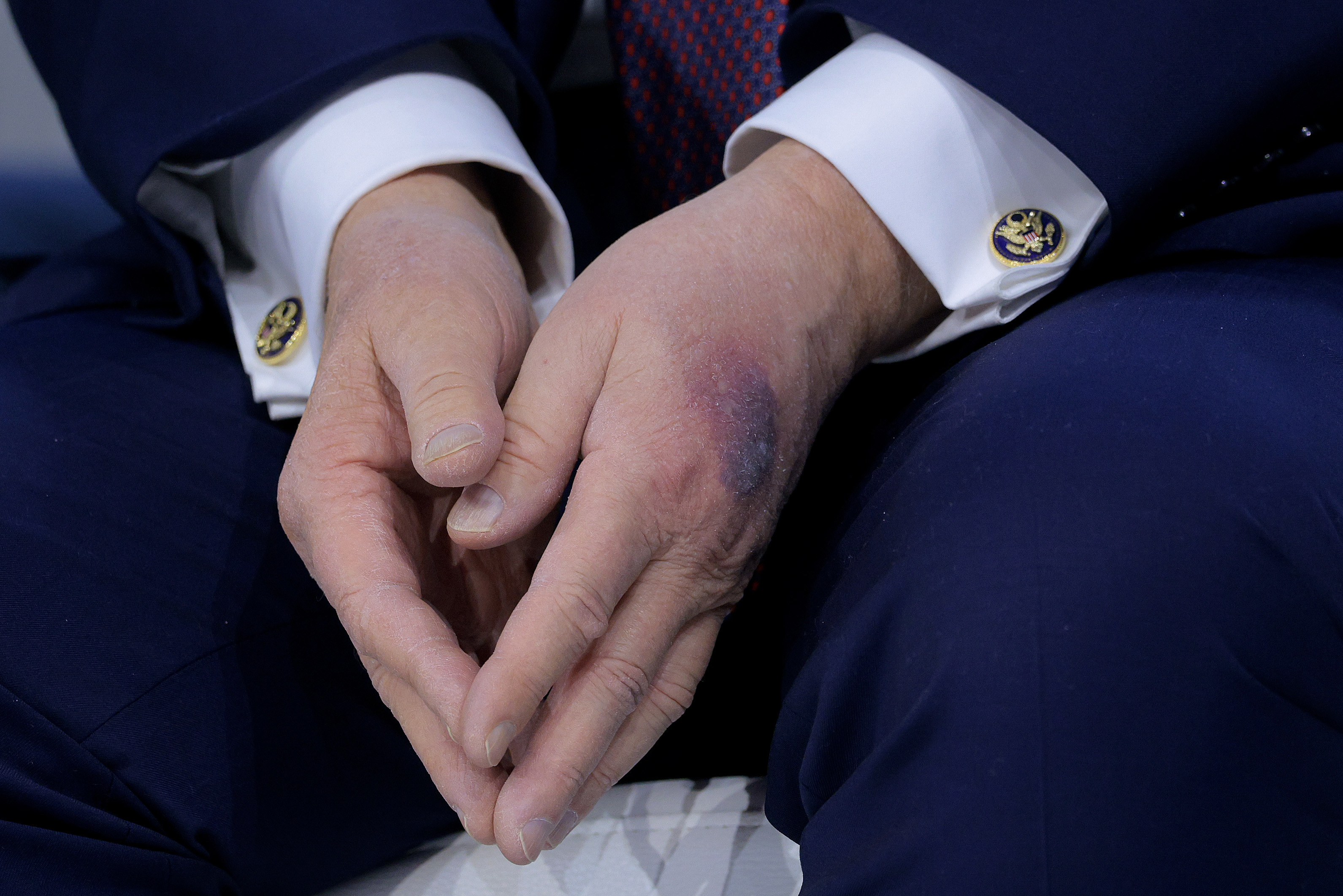 Enormous bruise spotted on Donald Trump's hand