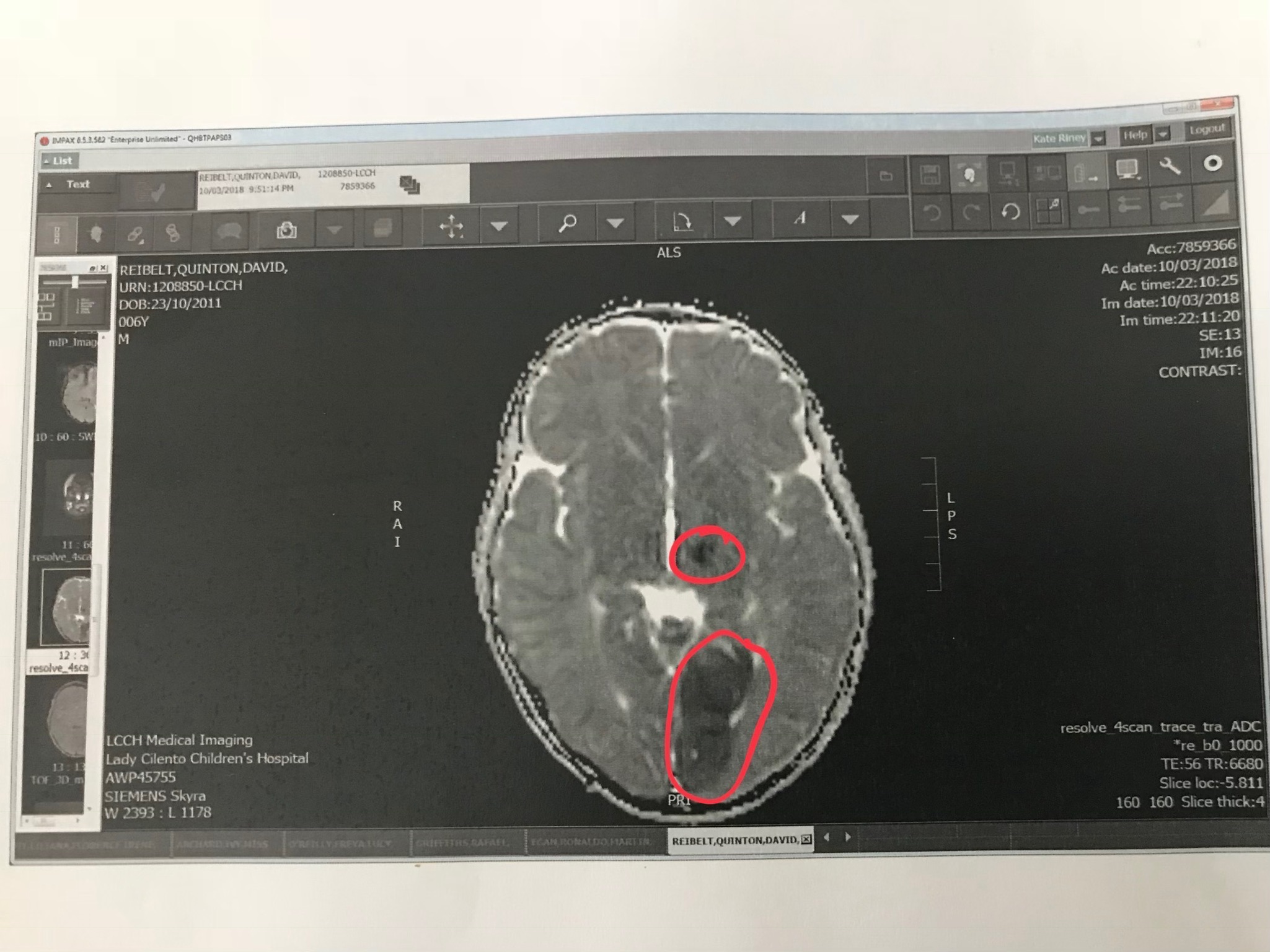 The scans which confirmed little Quinn had suffered a stroke in March.