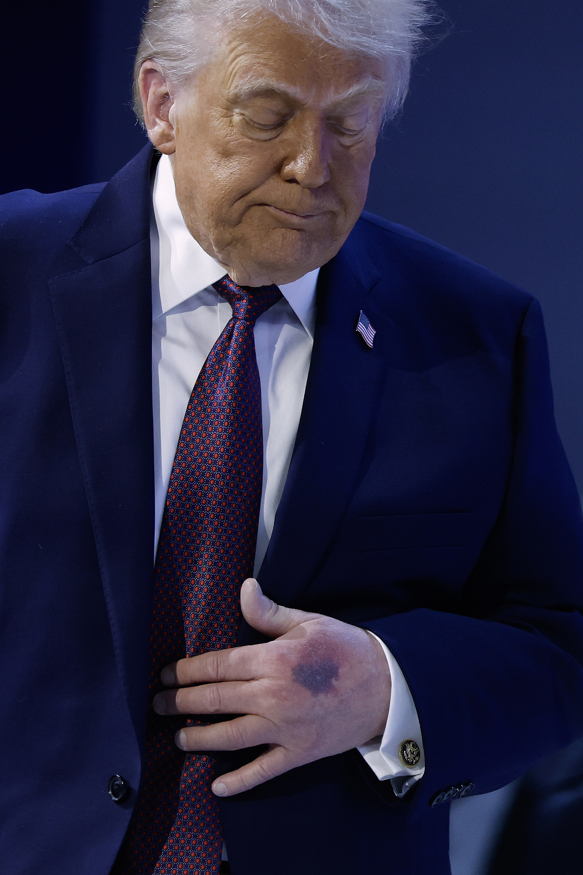 A bruise can be seen on the back of Donald Trump's left hand.