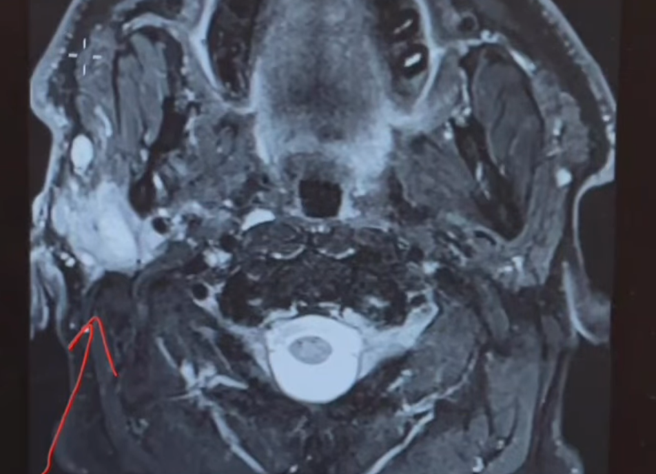 Scan showing Duncan Jones' cancer