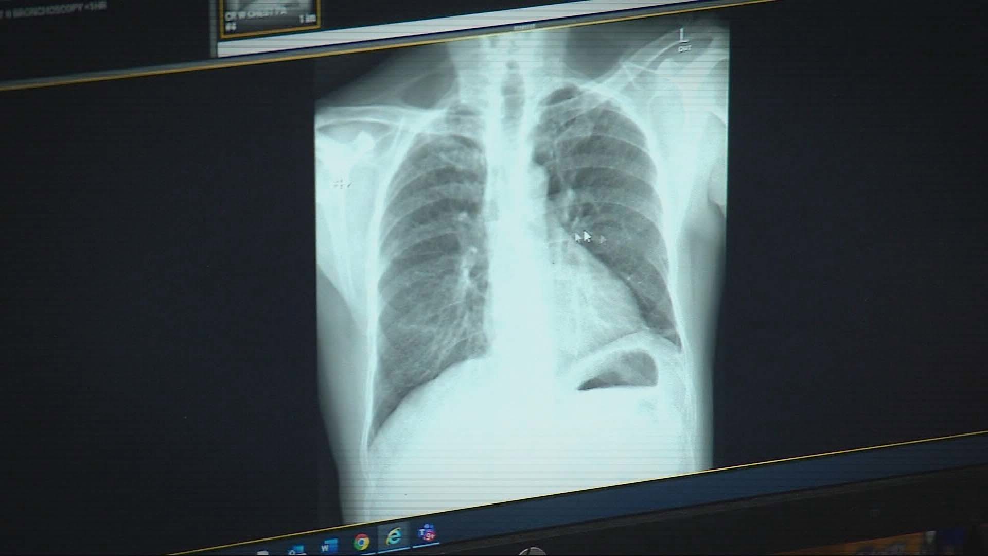 Workers in underground tunnels expected to contract silicosis, new study finds