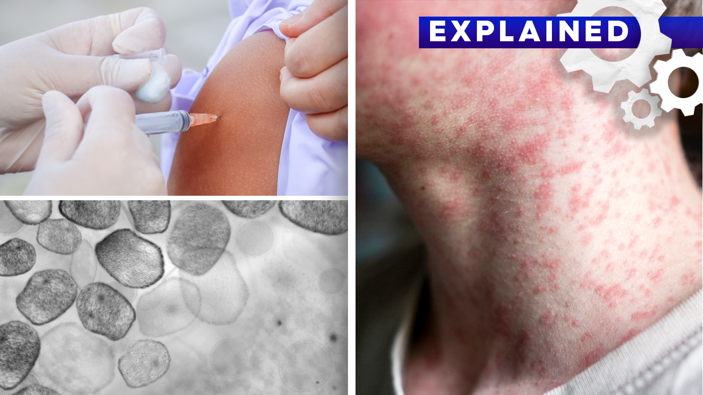 Endemic measles were eliminated in Australia in 2014. But case numbers are rising again