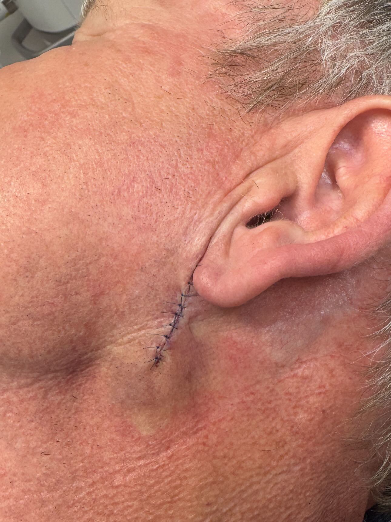 Gordon Ramsay skin cancer surgery