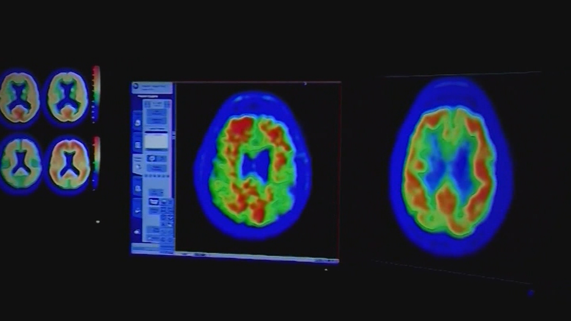 Adults between 60-69 who reported experiencing bad dreams are four times more likely to develop dementia.