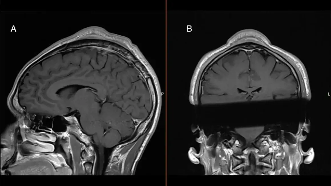 An MRI of a breaker's head shows the tumor that doctors believe developed due to repeated headspins. BMJ Case Reports 2024