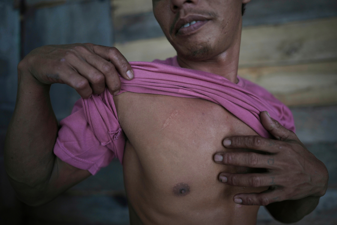 Suardi, a crocodile attack survivor, shows a scar on his chest in Budong-Budong, West Sulawesi, Indonesia