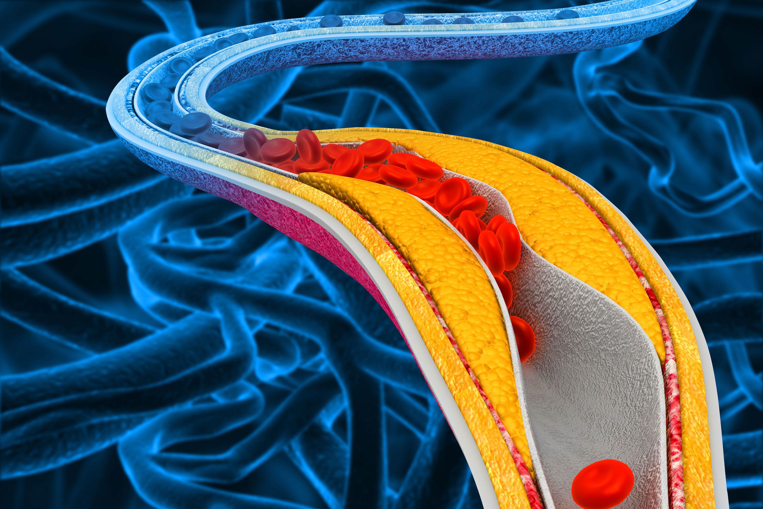 Having high cholesterol in the blood can lead to a buildup called "plaque" on the walls of the arteries, raising the risk of cardiovascular disease.
