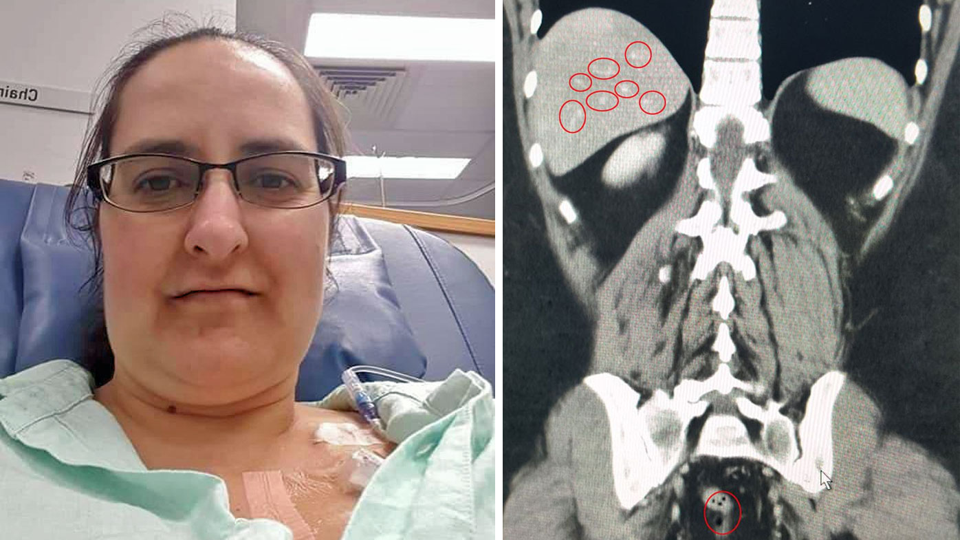 Ms Parkinson's cancer has spread from her colon to her liver.