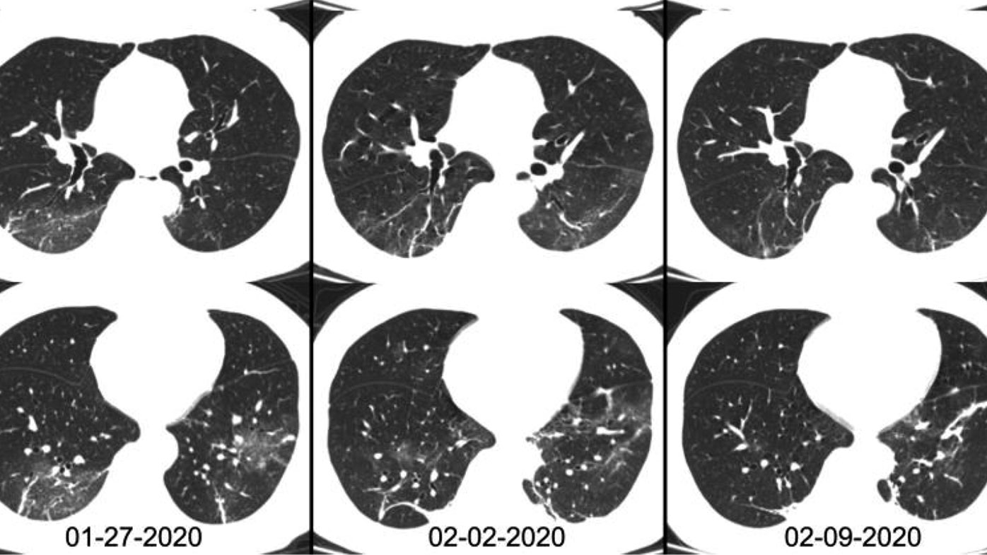 Chest CT images of a 46-year-old with coronavirus in China.