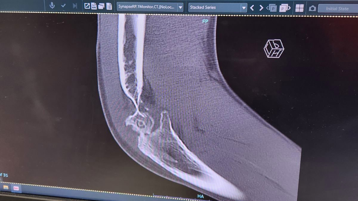 An x-ray of Kane Valenine's arm, where two thirds of the bone was worn away as it scraped along the road.