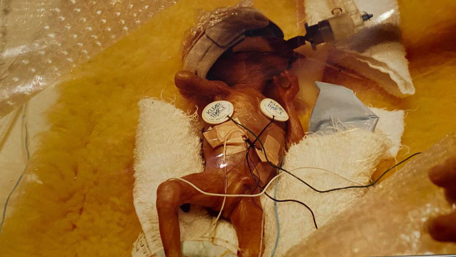 Jonathon Heeley was born weighing just 374 grams. His first bath was in a kidney dish.