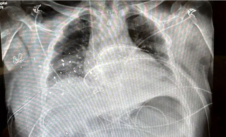 Rabbi Yanky Super's chest x-ray