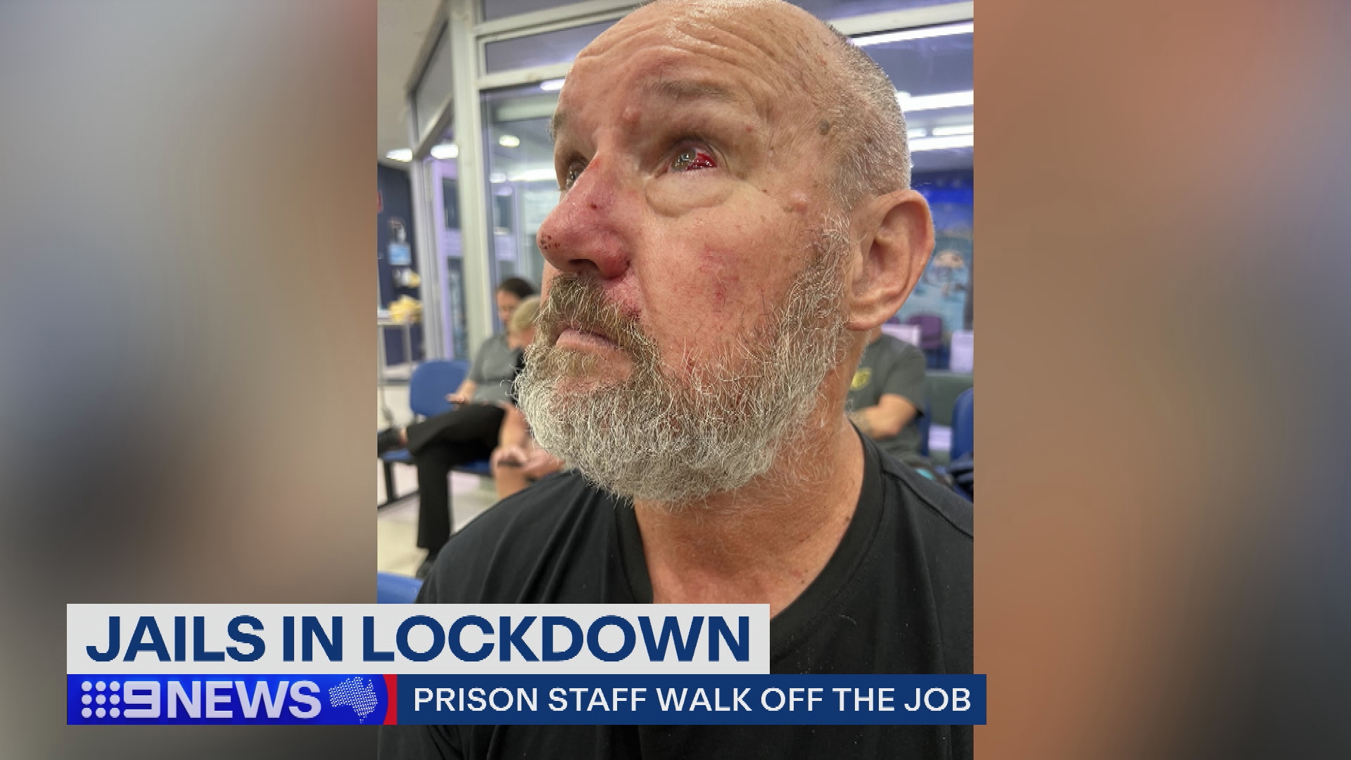 A man with an injured face after being attacked by an inmate at Cessnock prison.