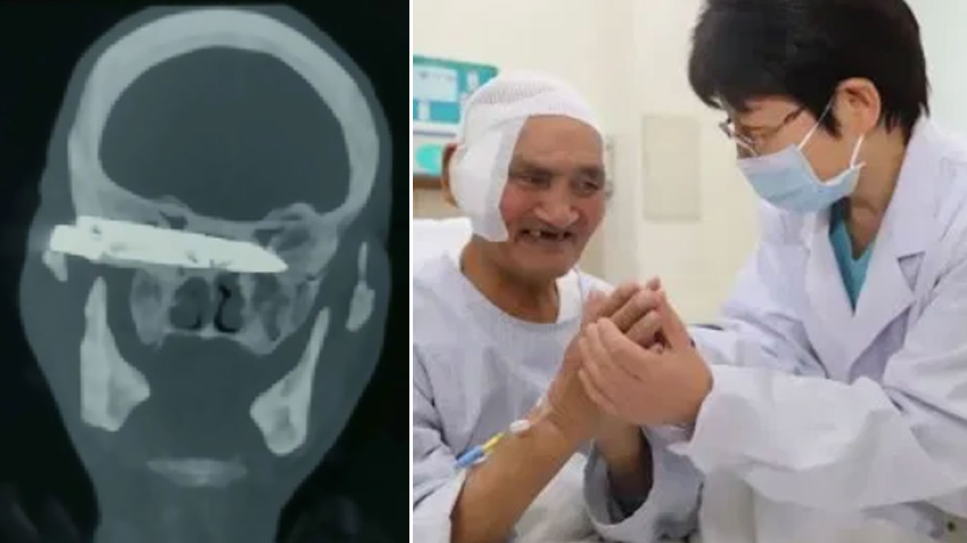 A man has had a knife removed from his skull years after a violent mugging.