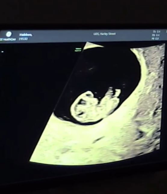 Sophie Habboo and Jamie Laing baby sonogram
