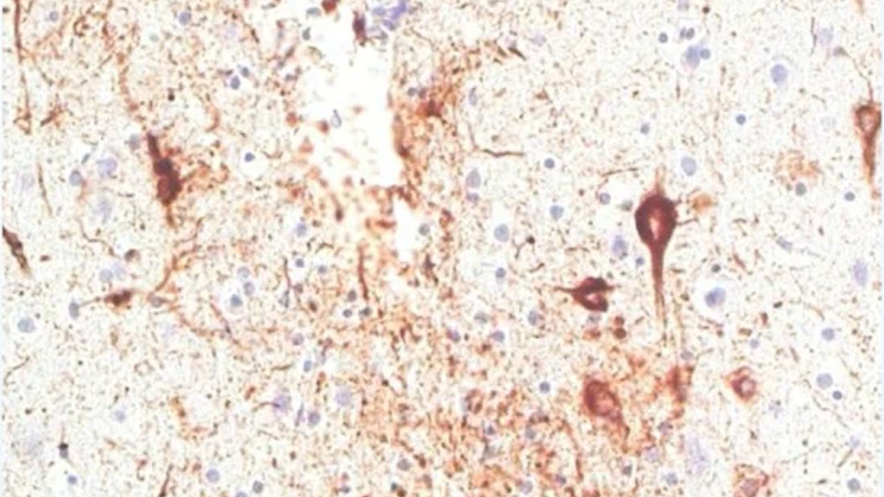 Paul Green's brain. The expert who studied Paul Green's brain after his death has revealed he suffered crippling CTEs. All the brown are CTEs.