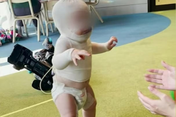 Baby Luka has undergone eight surgeries since the burning coffee was thrown on him.
