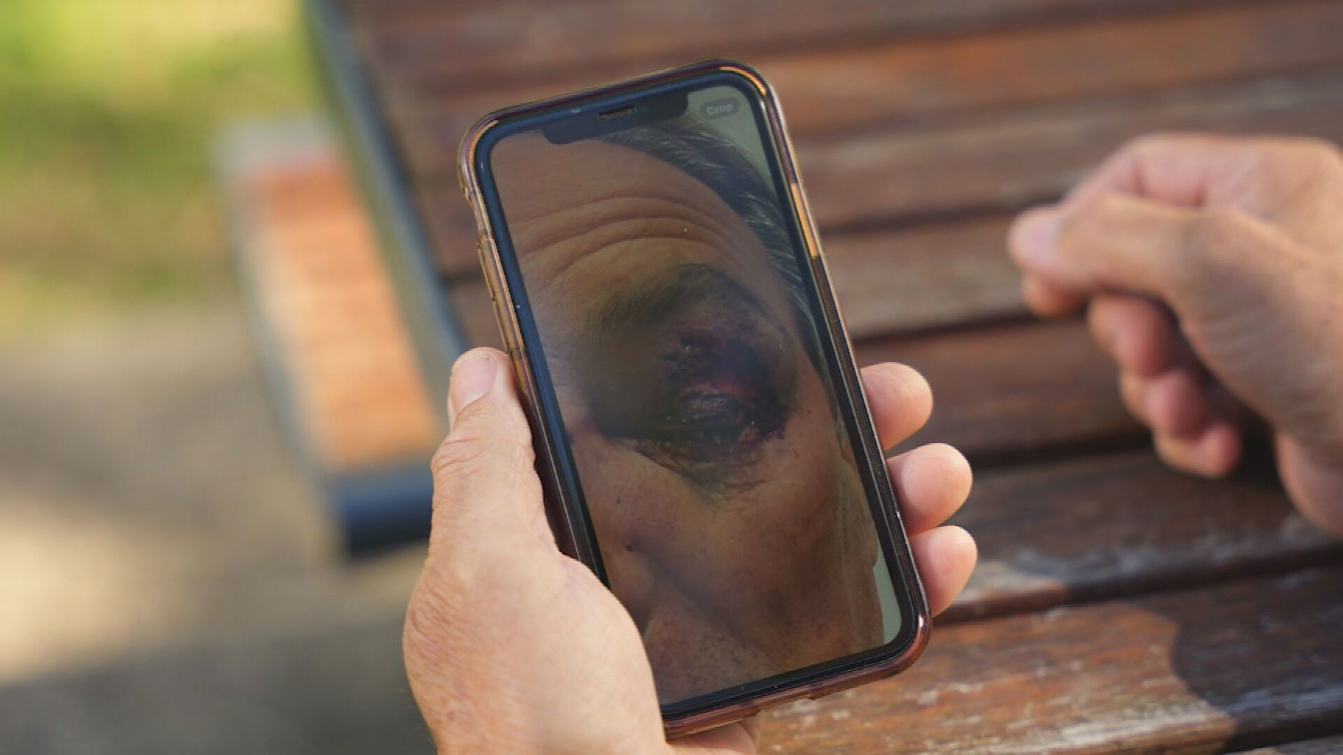 Ian said he was left with ﻿a bruised face, busted eye and bleeding on the brain.