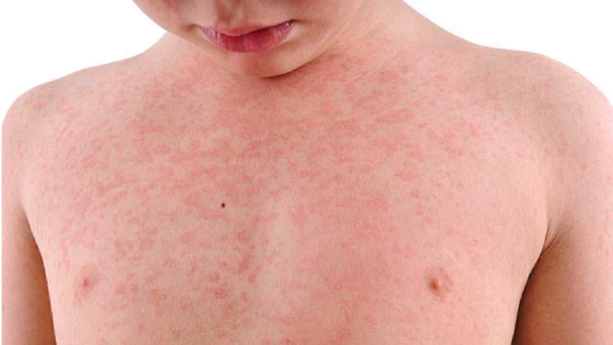 A new case of the measles has been reported in Victoria.