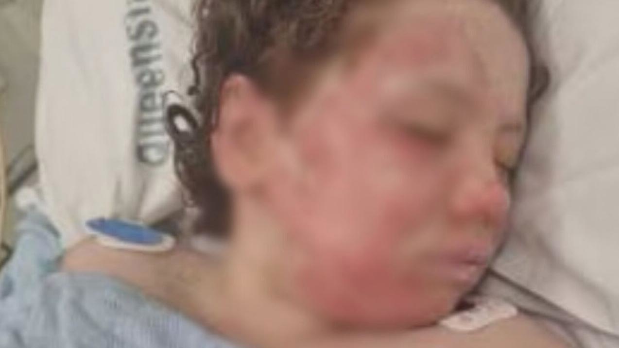 'Skin just falling off her': Girl left with burns after Temu jumper ignited An eight-year-old girl has been left with horrific burns after her jumper ignited while she was standing near a fire pit outside her home.