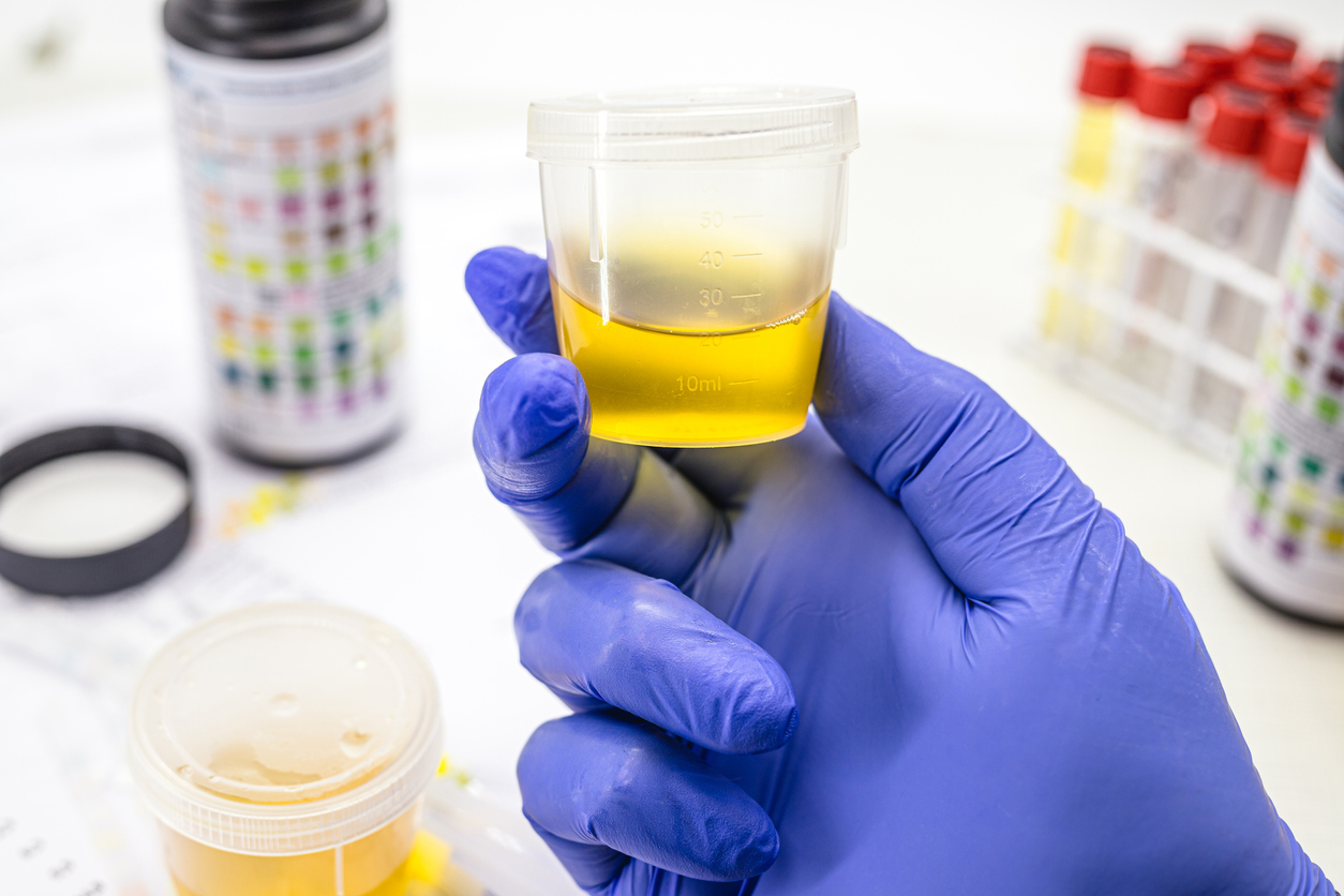 laboratorian hand with glove, performing EAS type urine test, Abnormal Sediment Elements.