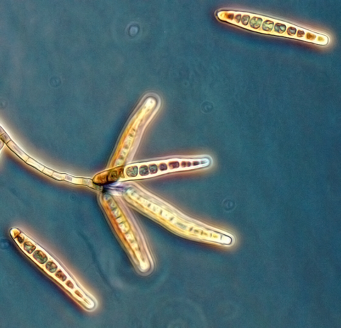 Fungal Meningitis