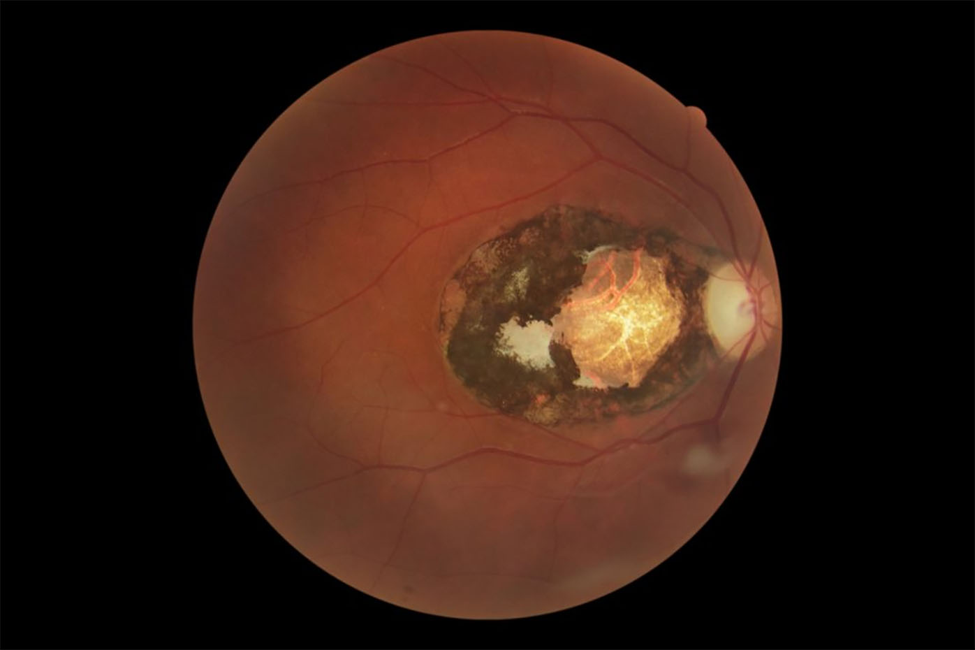 One in 150 Australians have retinal scars caused by the Toxoplasma parasite.