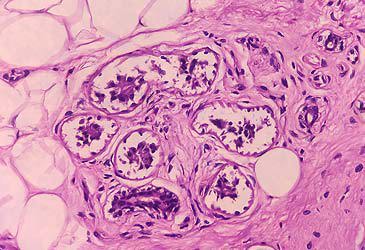 Microscopic image of malignant melanoma in pigmented ulcer (MD Abul Hosen/Getty)