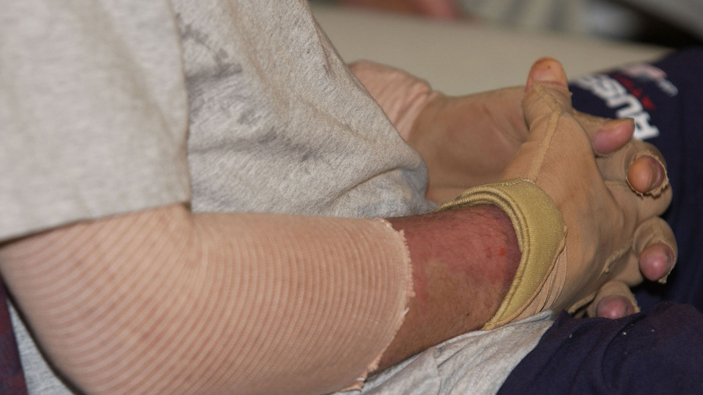 The Bali bomb survivor sustained serious injuries during the bomb attack 