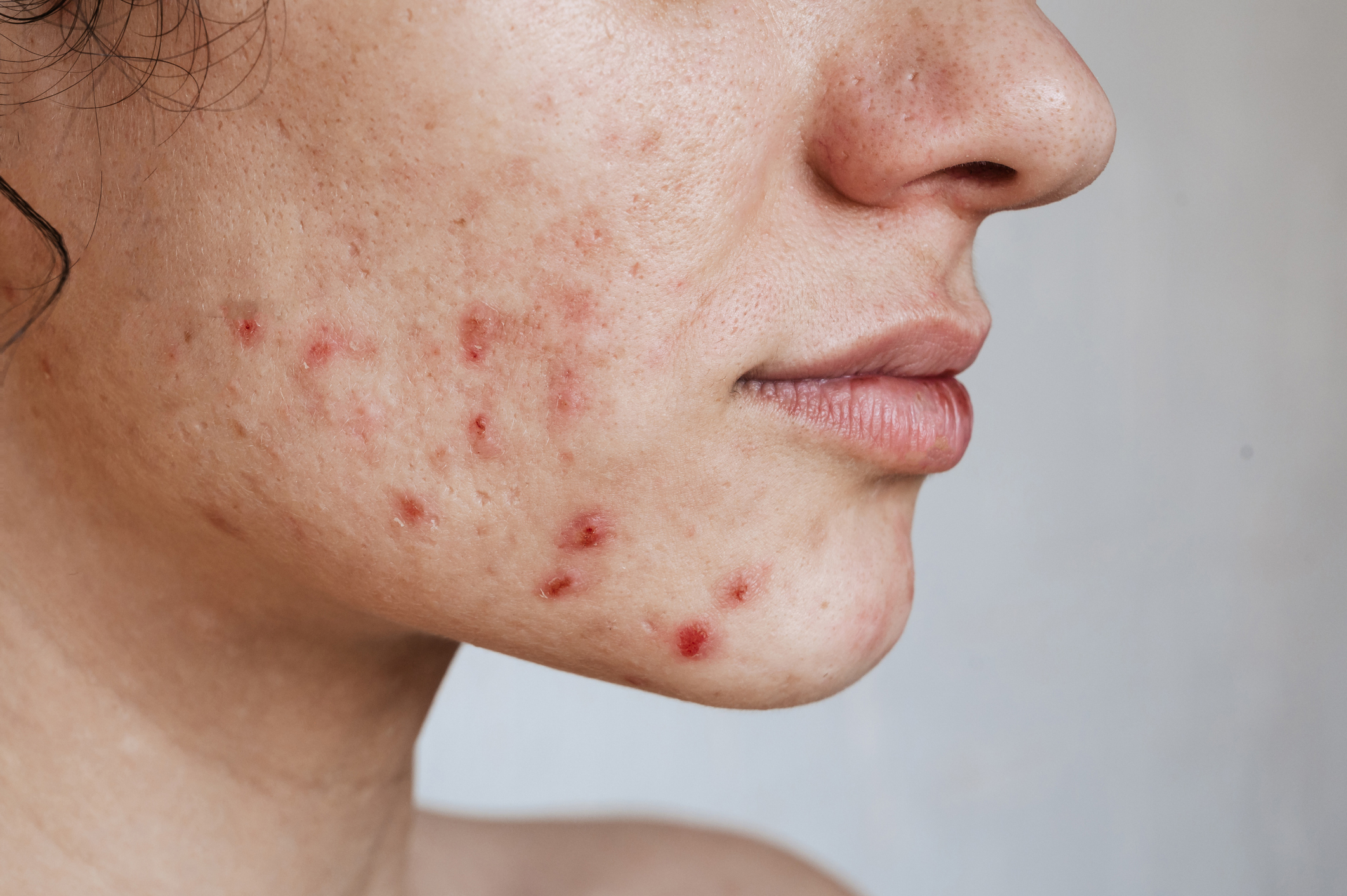 New technology treating stubborn acne without pills in Australian first
