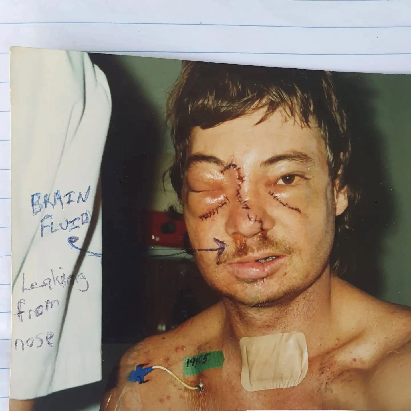 Paul Freeman said fluid leaked from his nose following the crash