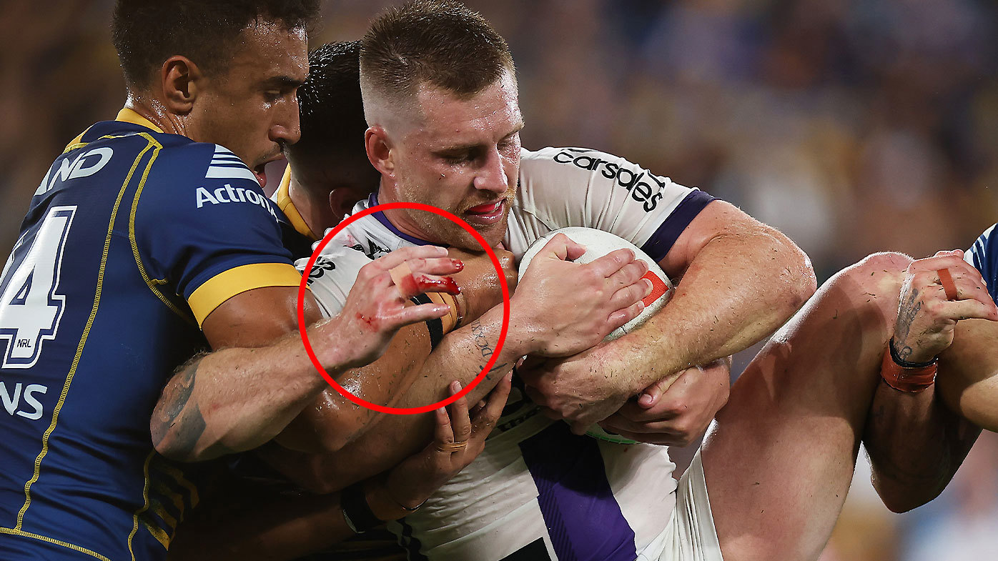 Cameron Munster's right hand was left bloodied after suffering a compound dislocation during the first half