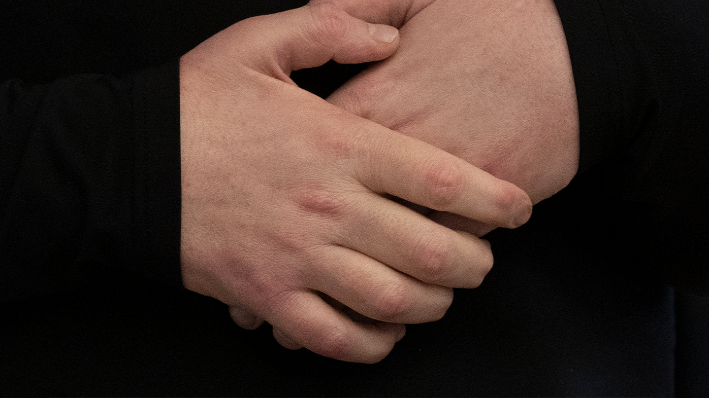 Joe DiMeo clasps his new hands, Jan. 25, 2021 in New York. In the months since his transplant surgery, DiMeo has not shown any signs of rejecting his new face or hands. (AP Photo/Mark Lennihan)