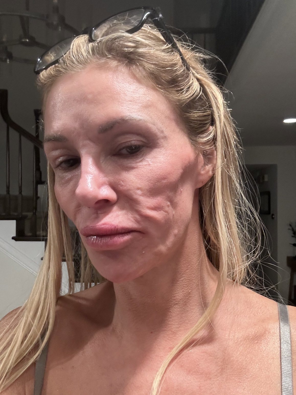 Brandi Glanville face disfigurement