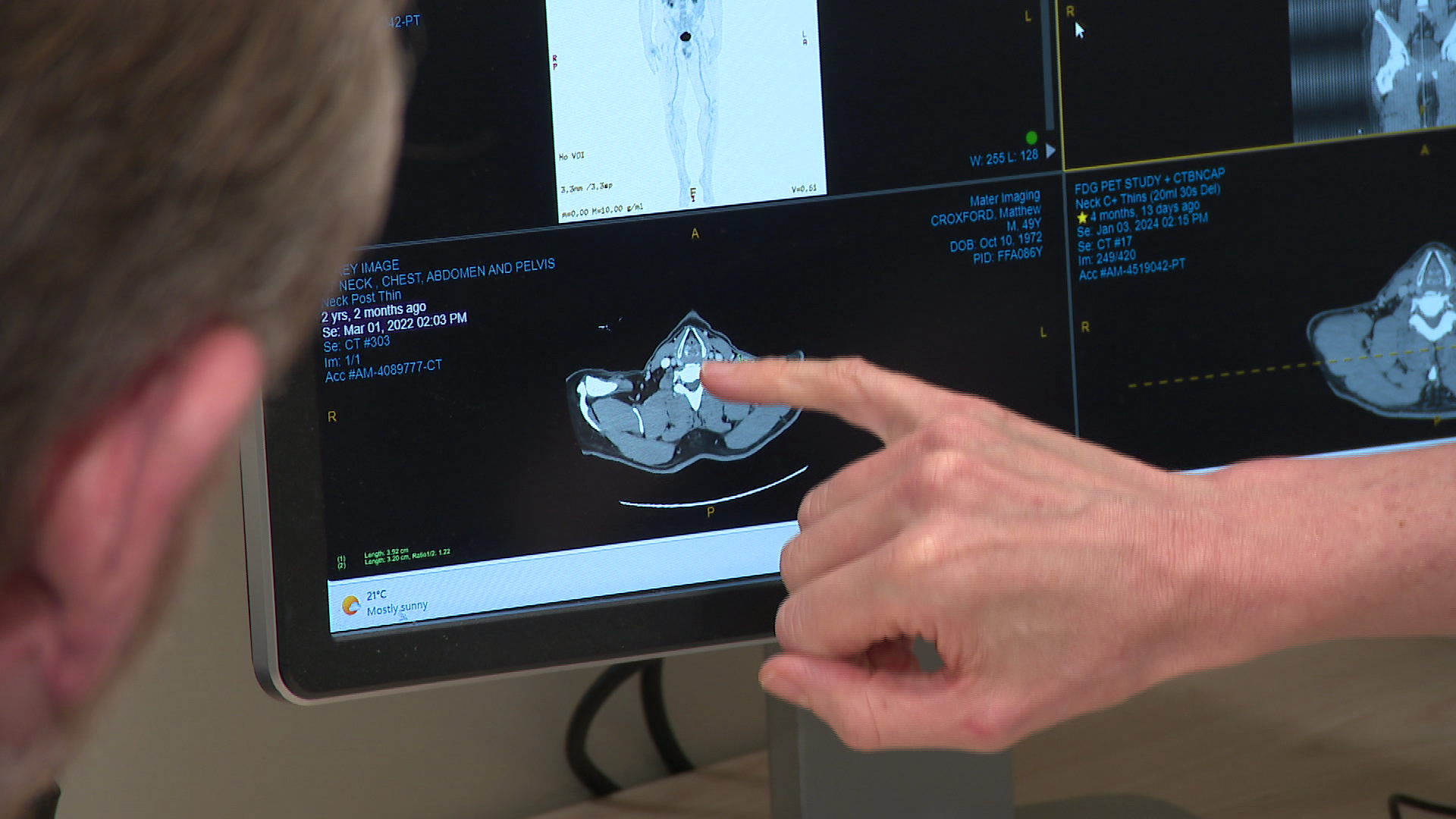 A revolution in the treatment of late-stage melanoma has been reached with clinical trial results seeing surging survival rates