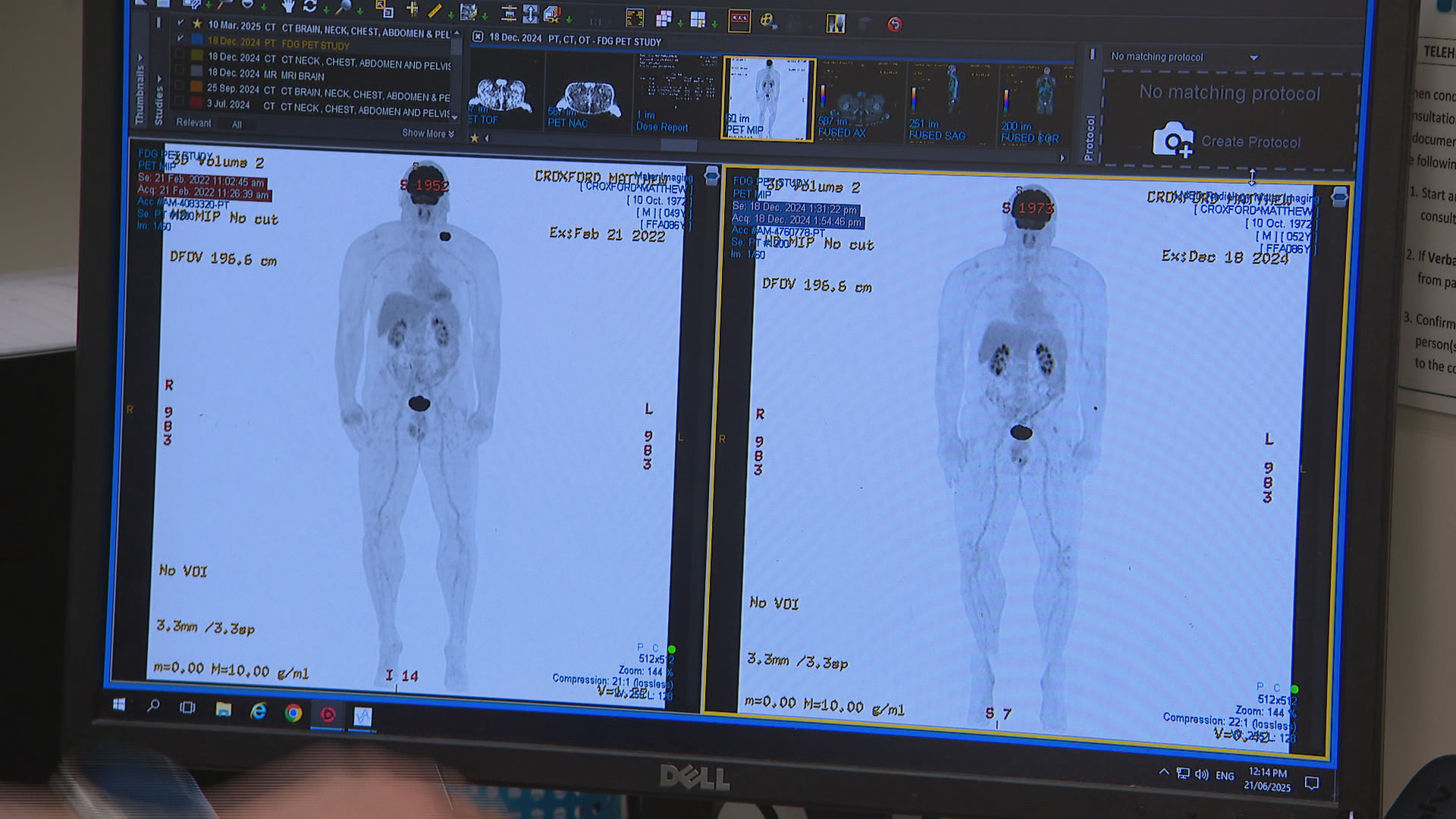 A new therapy has flipped the cancer paradigm on its head by giving the body the best opportunity to activate its own cancer-fighting defences.
