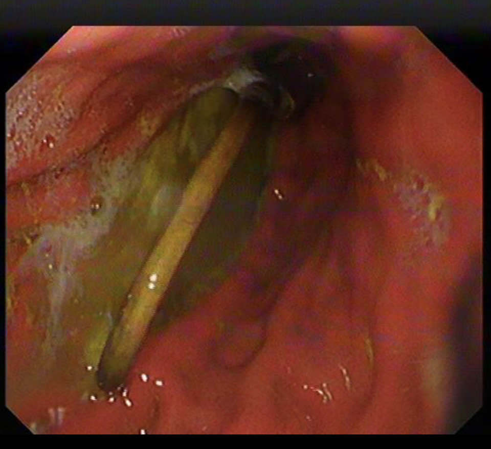 The cord was moved with care as it had started to pass into the small intestine.