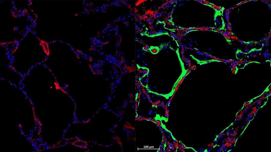 Left: Control Lung. Right: Immunofluorescent staining shows expression of new SARS-CoV-2 spike-receptor LRRC15 (green) in post-mortem lung tissue section from individual with COVID-19