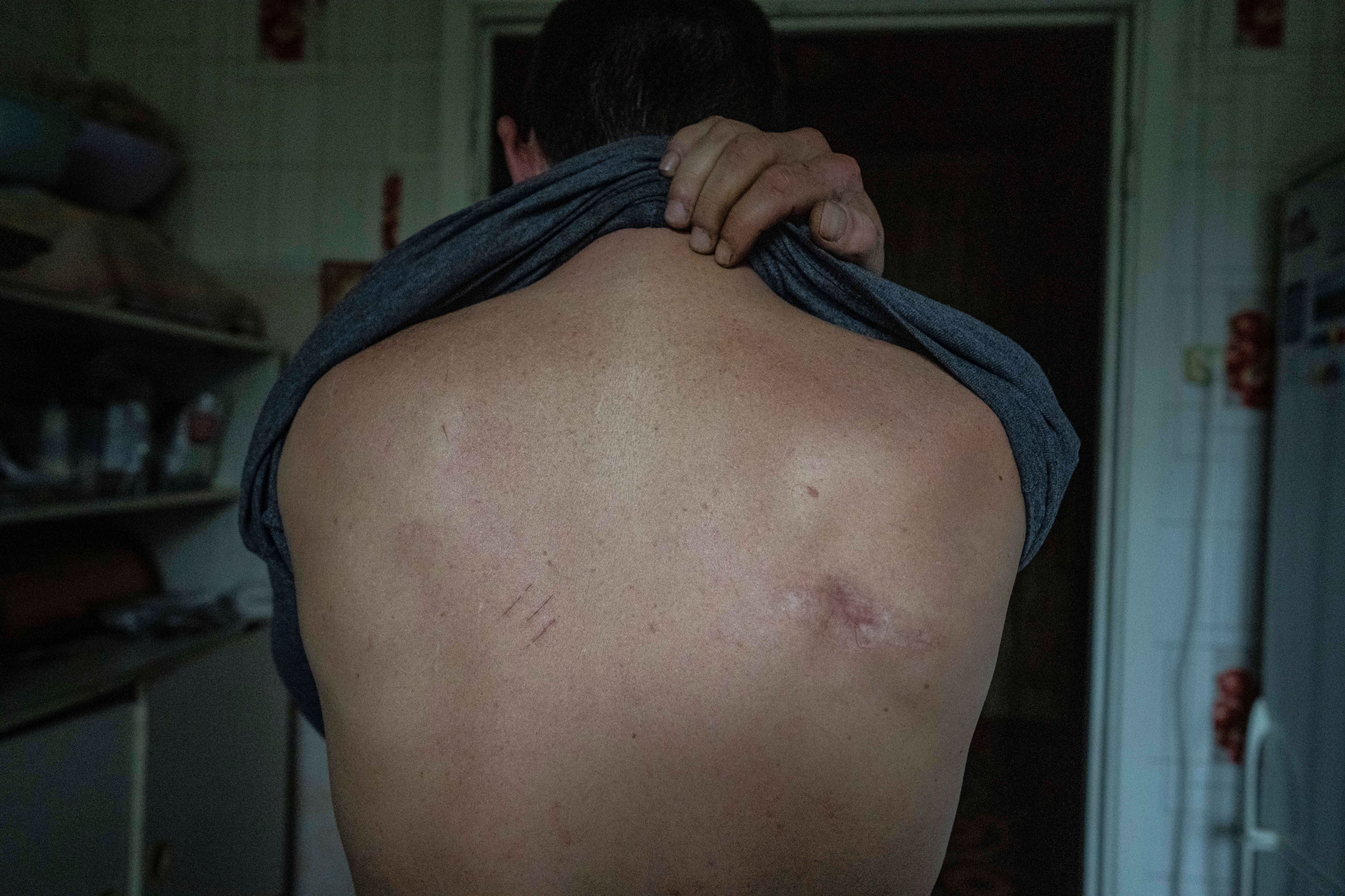 Mykola Mosyakyn shows scars on his back after torture by Russian soldiers